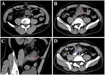 Case report: An unusual case of small bowel bleeding and common iliac artery pseudoaneurysm caused by an unnoticed swallowed toothpick